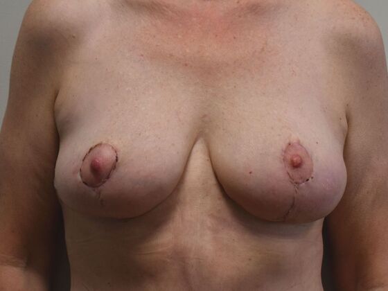 Breast Lift (Mastopexy) Case 213 - After