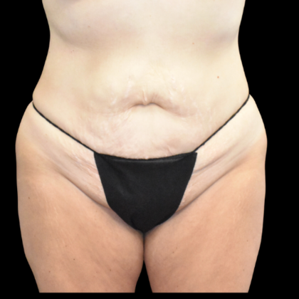 Abdominoplasty Case 16 - Before