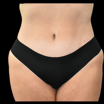 Abdominoplasty Case 16 - After