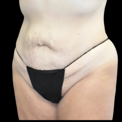 Abdominoplasty: Case 16 - Before