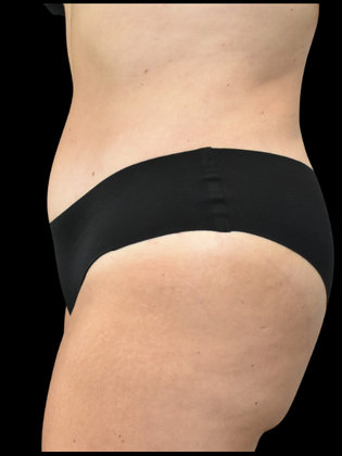 Abdominoplasty: Case 16 - After
