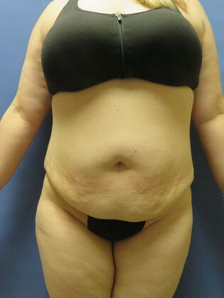 Abdominoplasty - Tummy Tuck Case 33 - Before