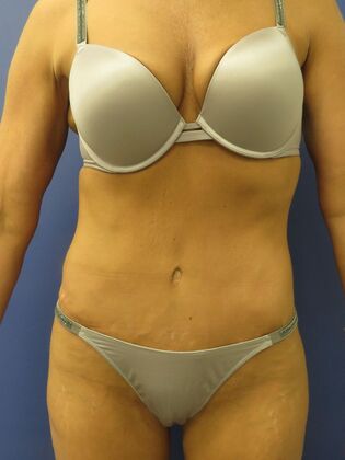 Abdominoplasty - Tummy Tuck Case 33 - After
