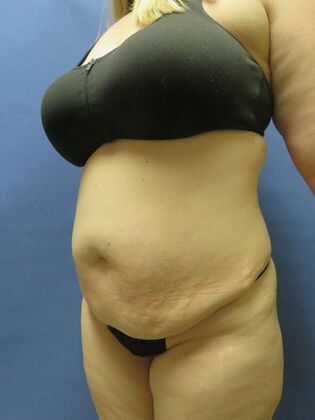 Abdominoplasty - Tummy Tuck: Case 33 - Before
