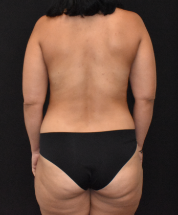 Mommy Makeover: Case 12 - Before