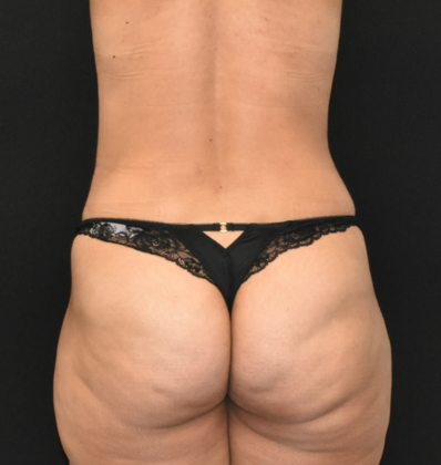 Mommy Makeover: Case 12 - After