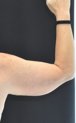 Brachioplasty: Case 4 - Before