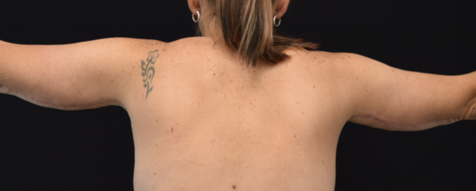 Brachioplasty Case 4 - After