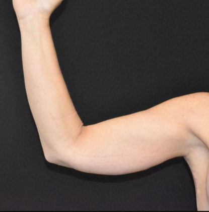 Brachioplasty: Case 4 - After