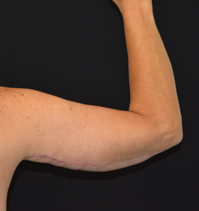 Brachioplasty: Case 4 - After