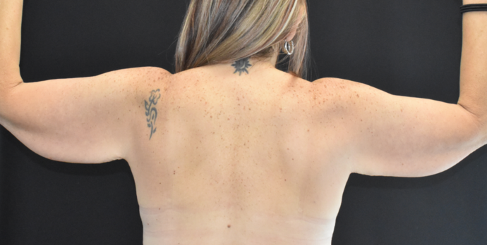 Brachioplasty Case 4 - Before