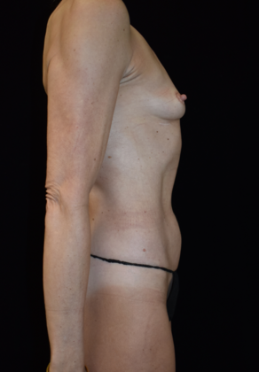 Mommy Makeover: Case 13 - Before