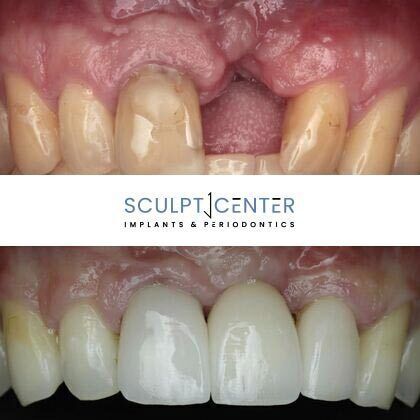 Dental Implants Cases