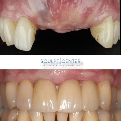 Dental Implants Case 2