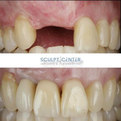 Dental Implants Case 3