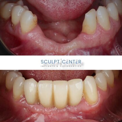 Dental Implants Case 4