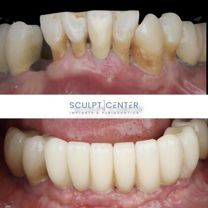 Dental Implants Case 5