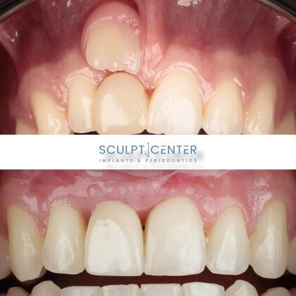 Dental Implants Case 6