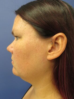 Chin Liposuction Case 3 - Before