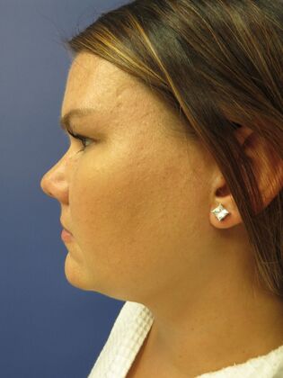 Chin Liposuction Case 3 - After