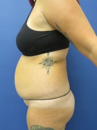 Liposuction Case 10 - Before
