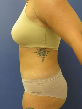 Liposuction Case 10 - After