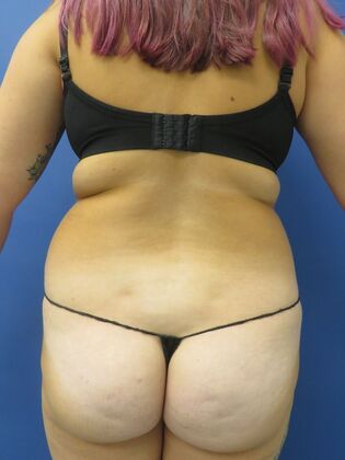 Liposuction: Case 10 - Before