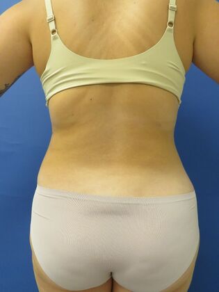 Liposuction: Case 10 - After