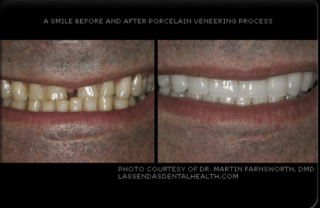 Veneers Case
