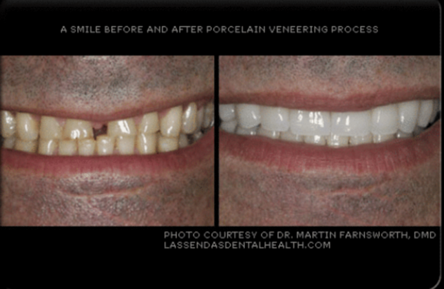 Veneers Case 1