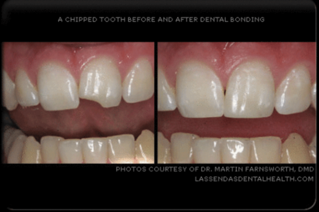 Dental Bonding Cases