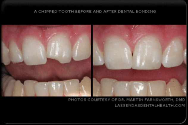 Dental Bonding Case 1