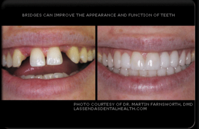 Dental Bridges Case 1