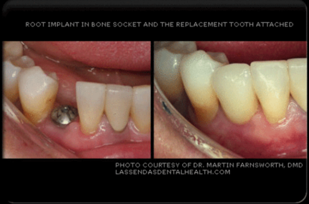 Dental Implants Case 1