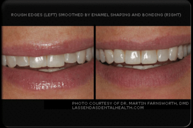 Dental Bonding Case 2