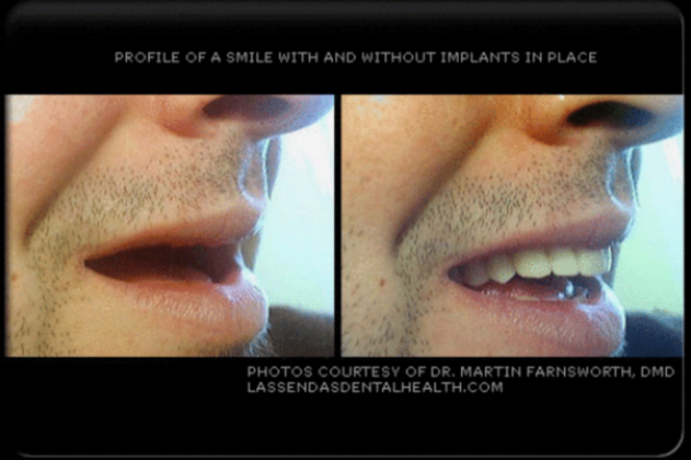 Dental Implants Case 2