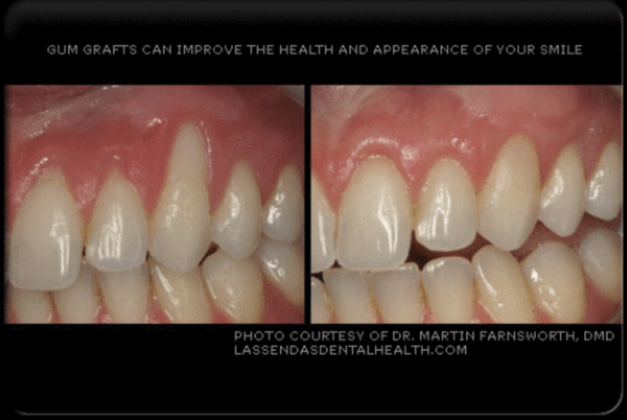 Gum Grafting/Reshaping Cases