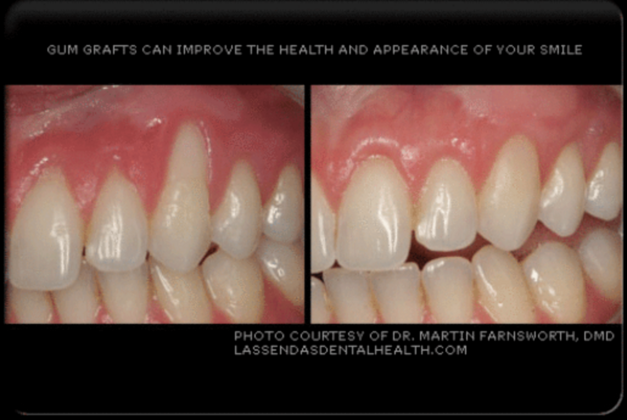 Gum Grafting/Reshaping Case 1