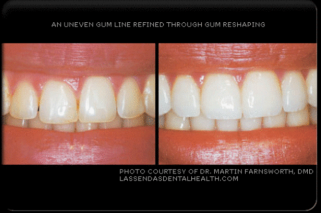 Gum Grafting/Reshaping Case 2