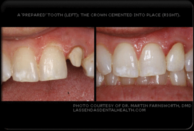 Dental Crowns Case