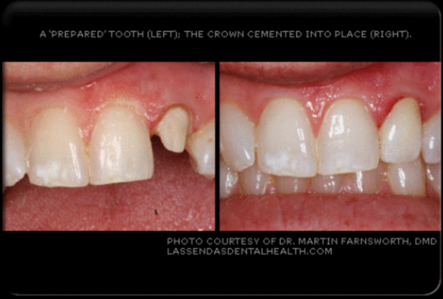 Dental Crowns Case 1