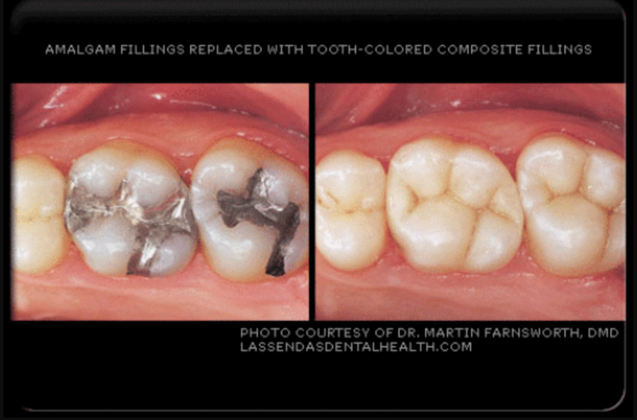Fillings Case