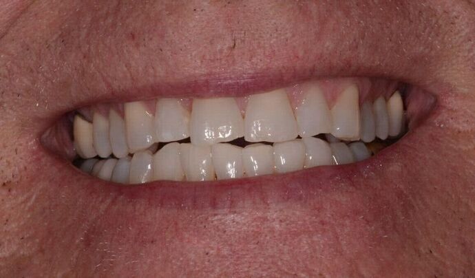 Porcelain Veneers Porcelain Veneers to Update Smile - Before