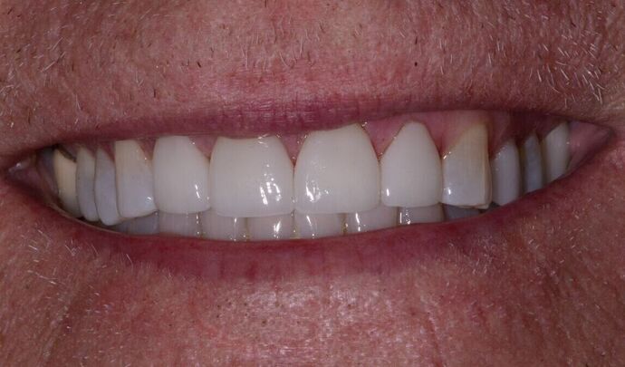 Porcelain Veneers Porcelain Veneers to Update Smile - After