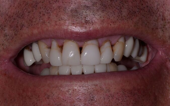 Malformed Smile & Missing Teeth: Permanently Fixed Implant Retained Prosthesis - Before