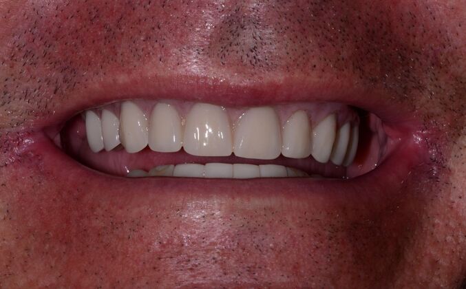 Malformed Smile & Missing Teeth: Permanently Fixed Implant Retained Prosthesis - After