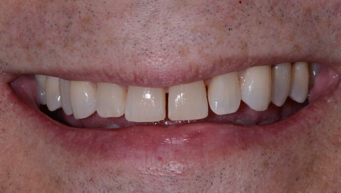 Malformed Smile & Missing Teeth: Composite Veneers to Correct Spacing - Before