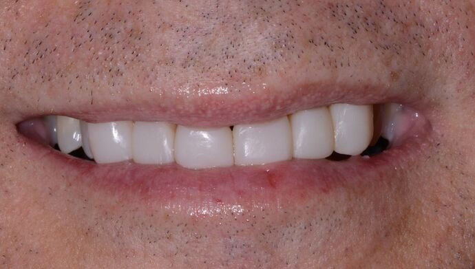 Malformed Smile & Missing Teeth: Composite Veneers to Correct Spacing - After