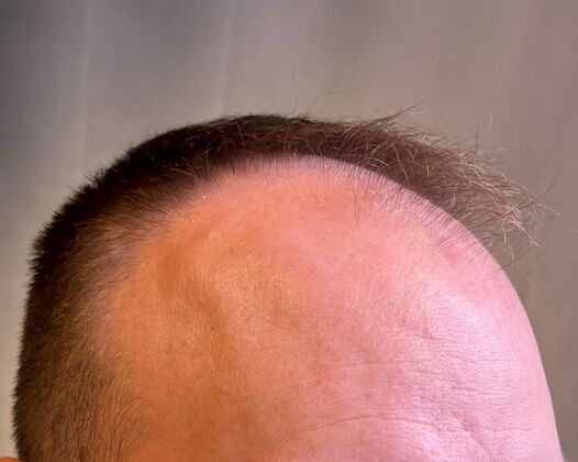 FUE Hair Restoration: Case 38 - Before