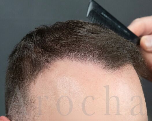 FUE Hair Restoration: Case 38 - After
